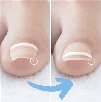 services_onyfix_nail_correction